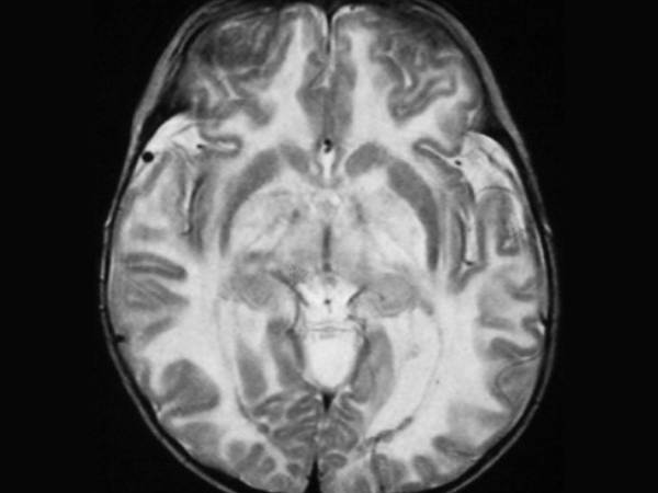 Canavan Disease_ Types, Causes, Diagnosis and Treatment