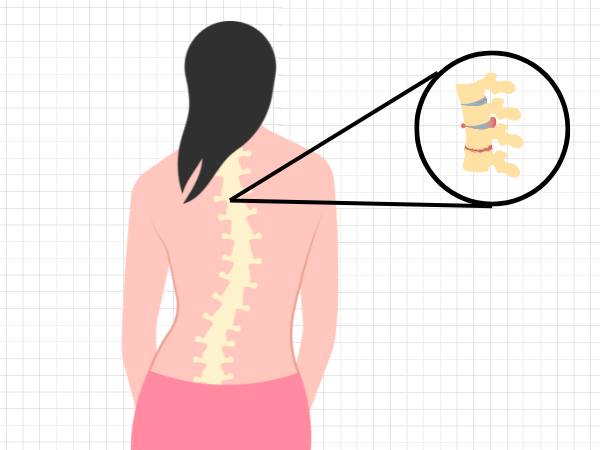 Lumbar spondylosis_ causes, symptoms, and treatments