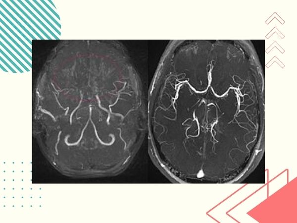 Moyamoya disease - Types, Symptoms and treatment