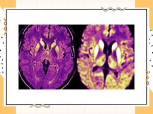 Prion Disease_ Symptoms, Causes, Types, & Treatment