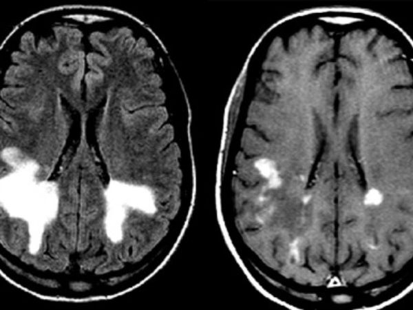 Schilder's Disease_ Symptoms, Causes, & Treatment