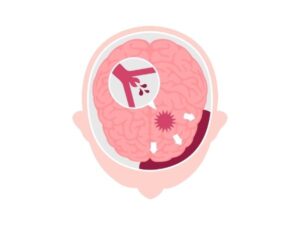 Subarachnoid hemorrhage - Types, Causes and treatment