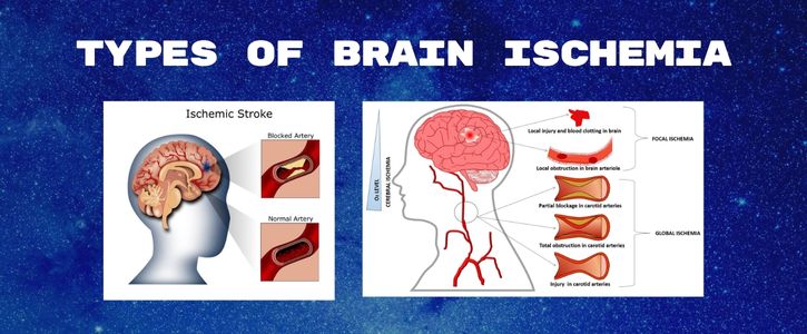 Types of Brain Ischemia