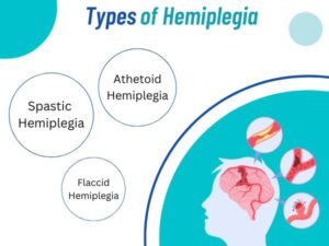 Types of Hemiplegia - Dr Deepak Agrawal