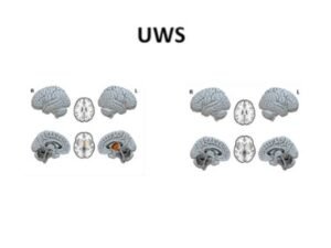 Vegetative State (Unresponsive Wakefulness Syndrome)