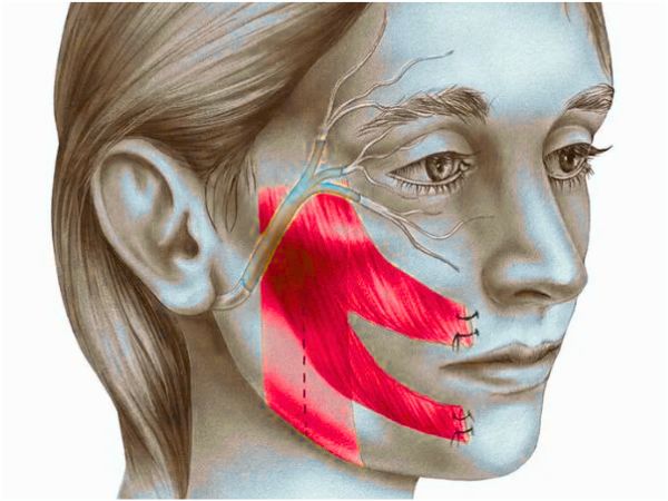 Facial Reanimation Procedures (Facial Palsy)