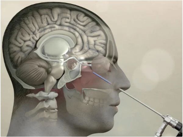 Endoscopic Endonasal