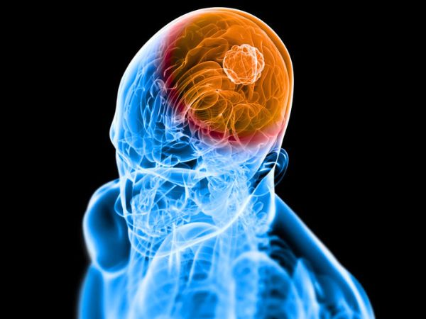 Do gliomas come in different types