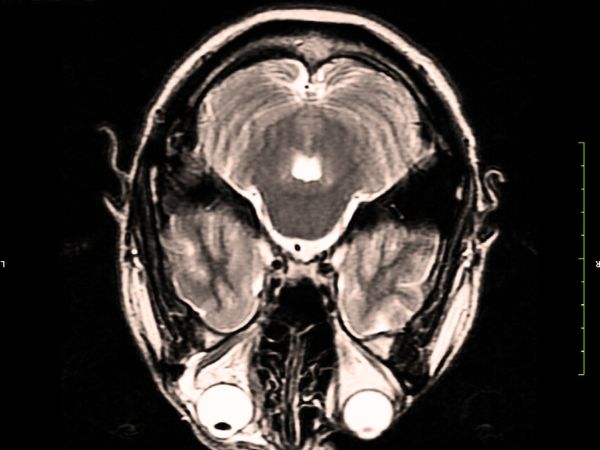 Gamma Knife Indications for Grade III AVMs