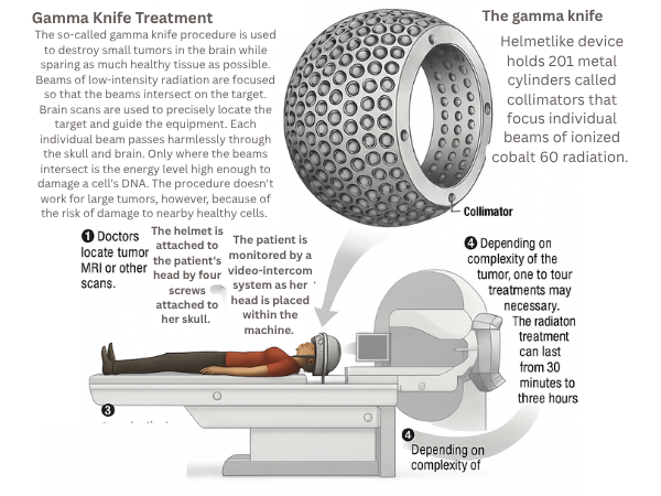 Glioma Gamma Knife Radiosurgery