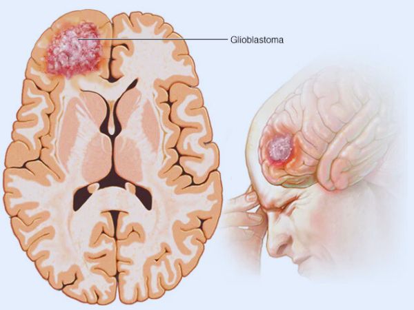 Glioma symptoms
