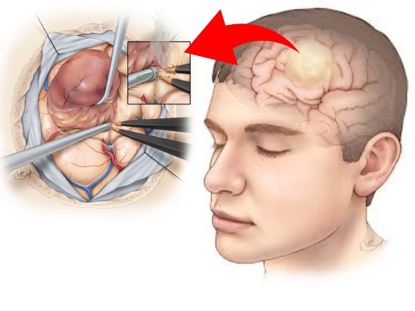 Gliomas_ What Are They