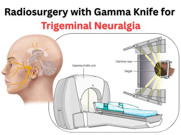 Radiosurgery with Gamma Knife for Trigeminal Neuralgia