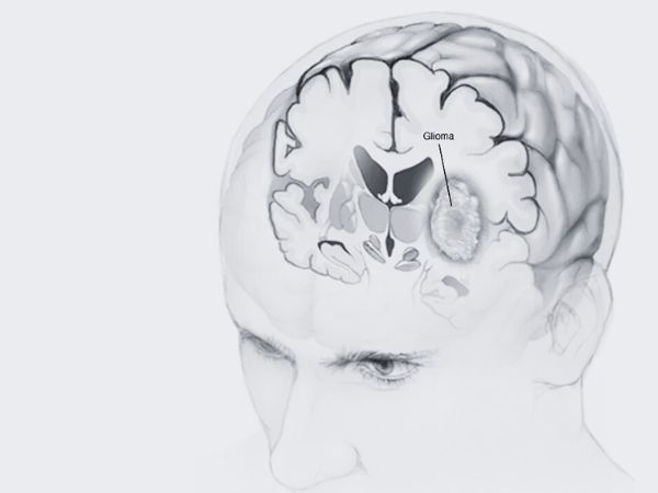 Who is susceptible to gliomas