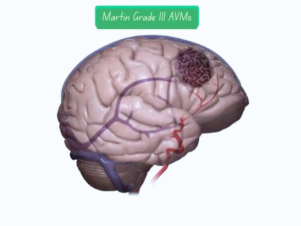 Why Spetzler-Martin Grade III AVMs Are Different