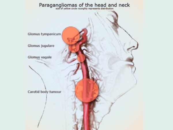 A Glomus Jugulare Tumor
