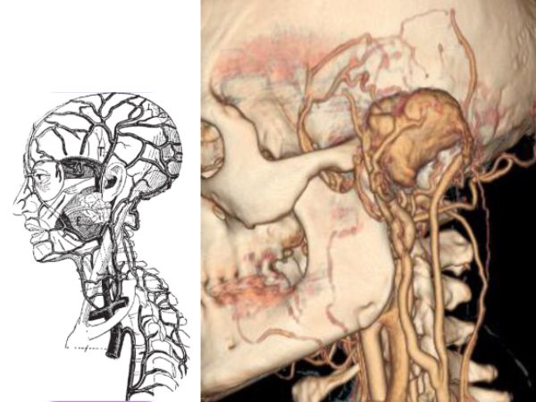 Gamma Knife Radiosurgery Glomus Jugulare