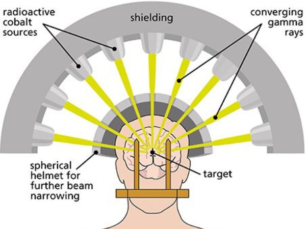 Gamma Knife Radiosurgery