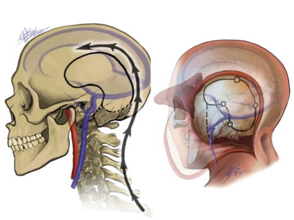 Glomus Jugulare Tumour Symptoms