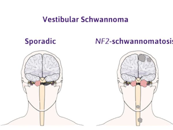 Gamma Knife Radiosurgery for Vestibular Schwannomas in NF2