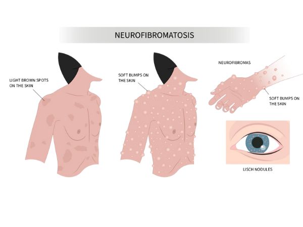 NF2_ What is it