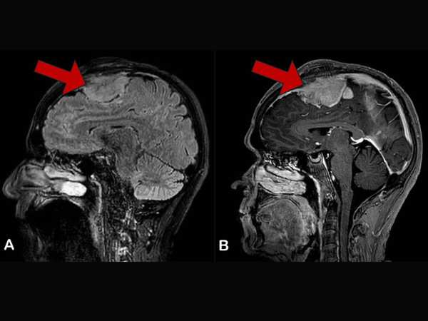 Parasagittal and Parafalcine Meningiomas Reasons & Risks