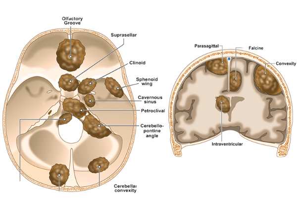 Parasagittal and Parafalcine Meningiomas