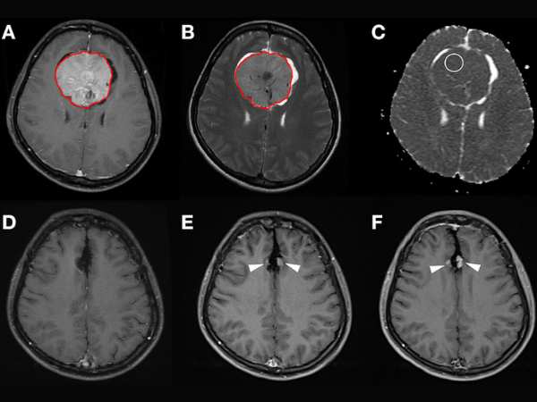 Parasagittal_Parafalcine Meningioma Symptoms