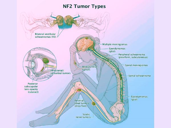 Vestibular Schwannoma symptoms in NF2