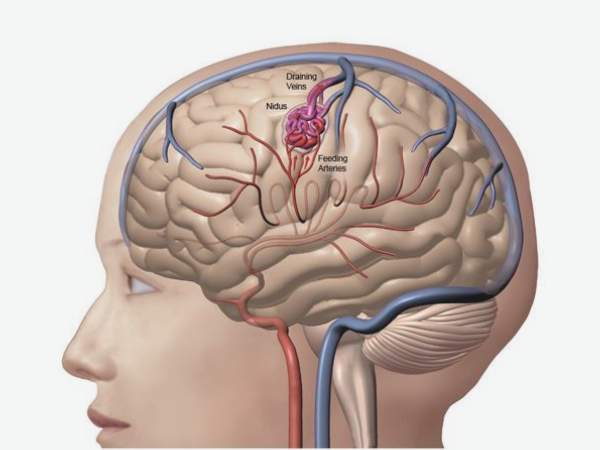 AVMs in the Basal Ganglia