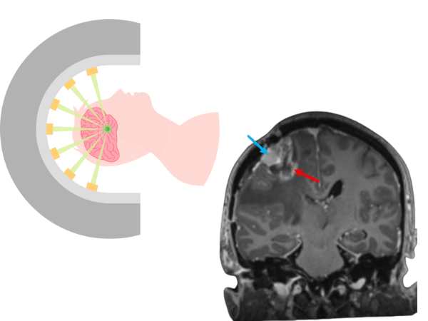 Atypical Meningioma (2)