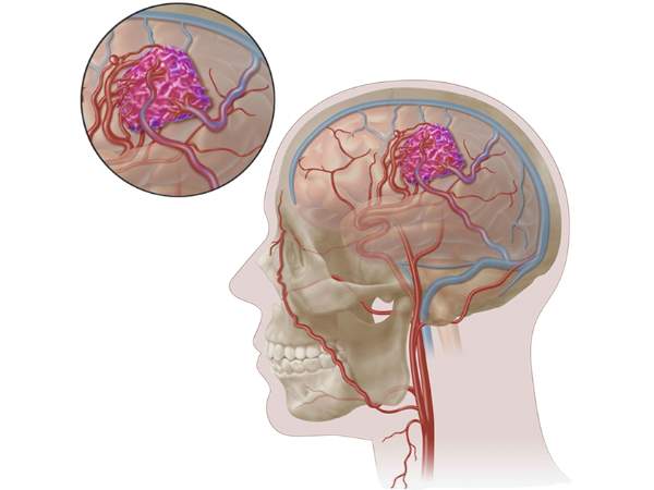 Basal Ganglia & Thalamic Arteriovenous Malformations