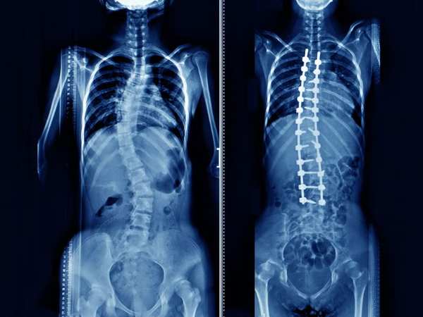 Different Osteotomy Types for Scoliosis
