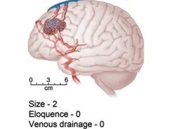 Recognising AVMs in the Thalamus and Basal Ganglia