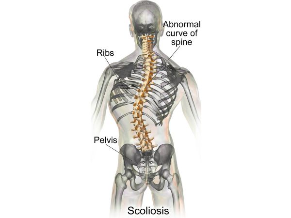 Scoliosis What is it