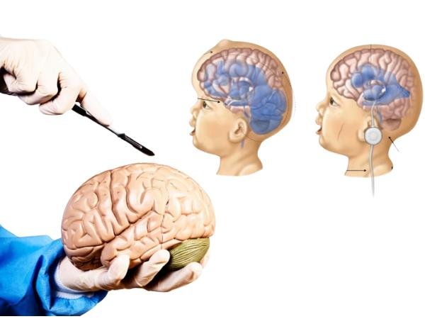 Brain Shunt Surgery