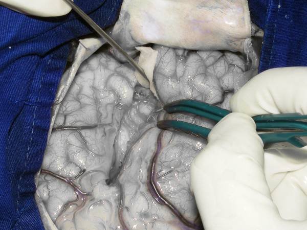 Complication Rate & Risks