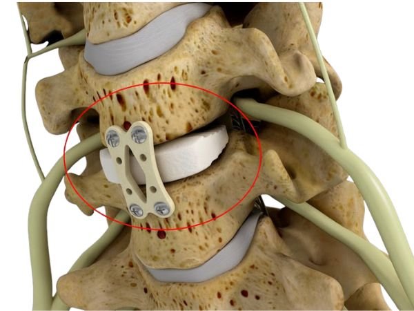 Cervical Discectomy Surgery