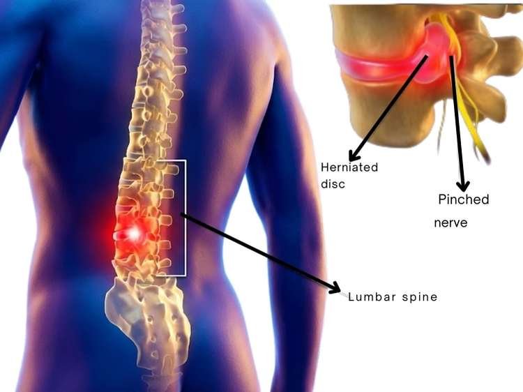 Lumbar Discectomy Surgery