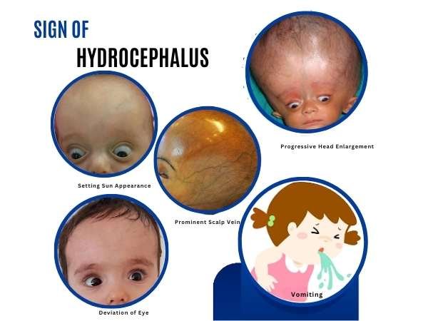 Typical Symptoms in Babies