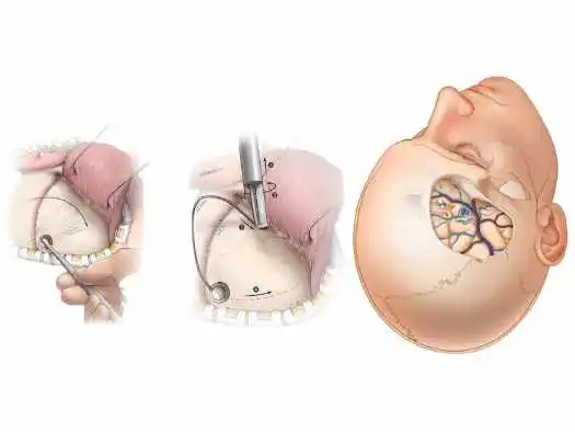 Steps and procedures that take place during brain surgery