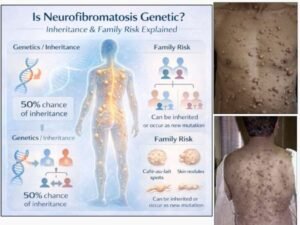 Is Neurofibromatosis Genetic