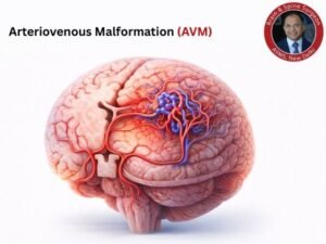 Arteriovenous malformation in the brain