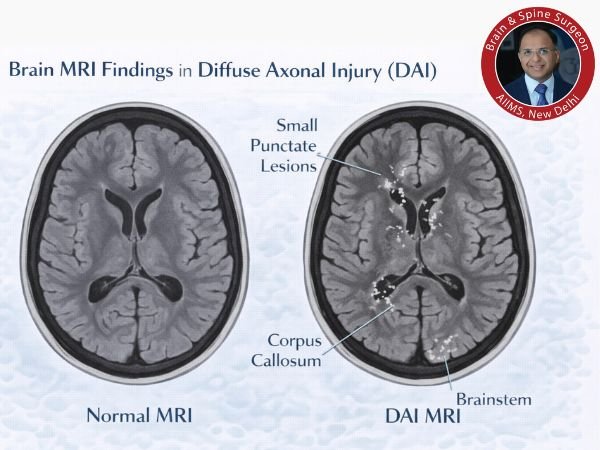 Brain MRI comparison_ normal vs DAI