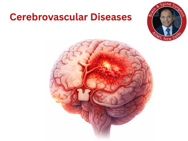 Cerebrovascular Diseases