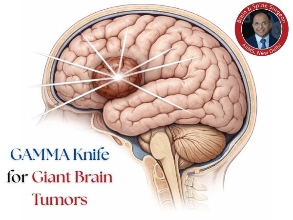 Gamma Knife for giant brain tumors
