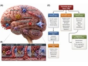 TBI (Traumatic Brain Injury)