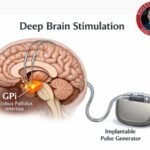 DBS Surgical Procedure