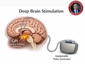 DBS Surgical Procedure
