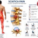 Sciatica pain_ causes, symptoms, treatment